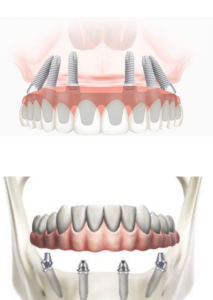 Proteze dentara fixa pe implanturi
